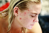 Изключително добро лечение на акне 29 от DermaVita Изключително добро лечение на акне 29