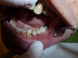 Offer for Dental Implants 17