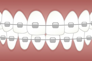 Our very best Dental Implants 22
