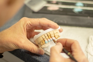 Best Deals on Dental Implants 25