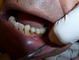 Info about Dental Implants 37