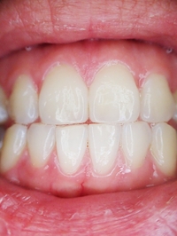 Offers for Dental Implants 5