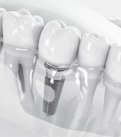 бондинг Варна - 68788 възможности | Dental Club бондинг Варна - 7750 възможности