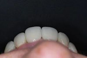 бруксизъм - 36615 предложения