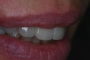 зъбни фасети - 69949 предложения