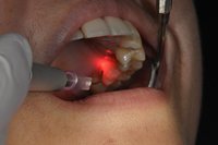 абсцес на зъб - 53413 възможности