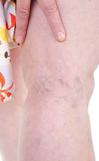 склеротерапия - 86267 типа